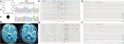 Case report: Functional analysis of the p.Arg507Trp variant of the PIGT gene supporting the moderate epilepsy phenotype of mutations in the C-terminal region